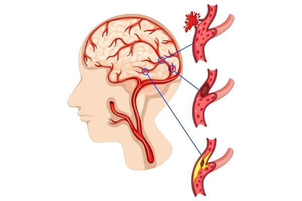 โรคหลอดเลือดสมอง สาเหตุ, โรค stroke